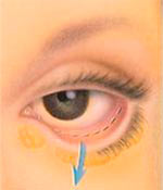 Øyelokk ved transconjuntival op legges snittet pa innsiden av nedre oyelokk